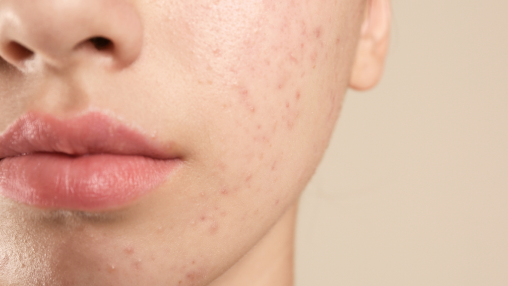 Acne Treatment Hertford