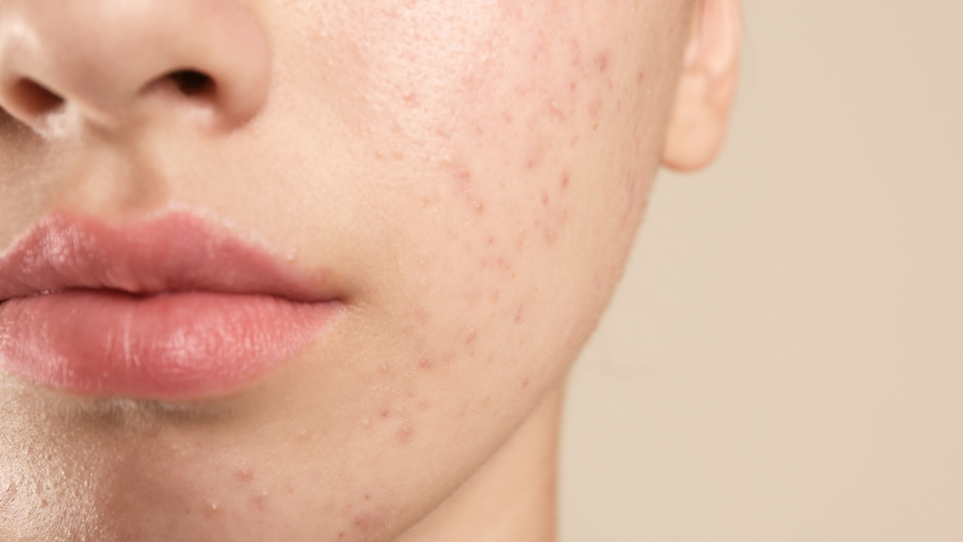 Acne Treatment Hertford